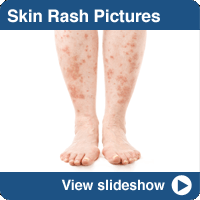 Pictures of Common Skin Rashes