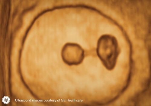 Week 7: Pregnancy Week By Week 3D Ultrasound Images