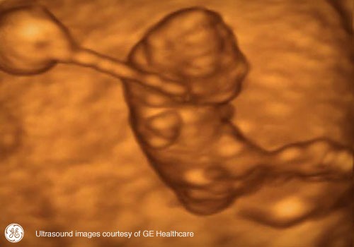 Week 8: Pregnancy Week By Week 3D Ultrasound Images