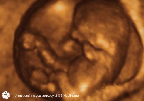 Week 10: Pregnancy Week By Week 3D Ultrasound Images