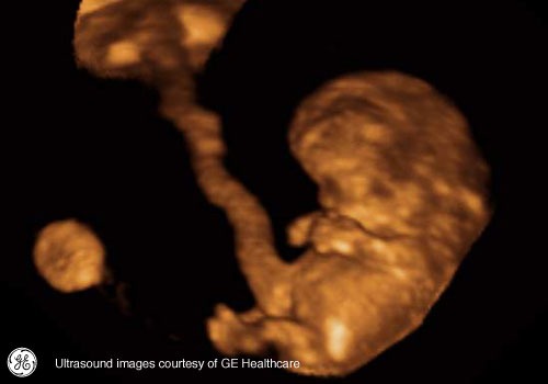 Week 11: Pregnancy Week By Week 3D Ultrasound Images