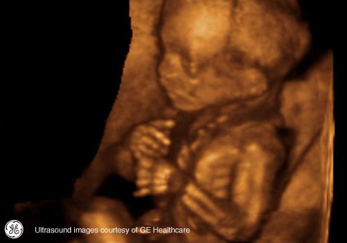 Week 17: Pregnancy Week By Week 3D Ultrasound Images