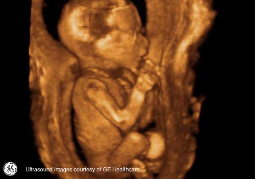 Week 18: Pregnancy Week By Week 3D Ultrasound Images