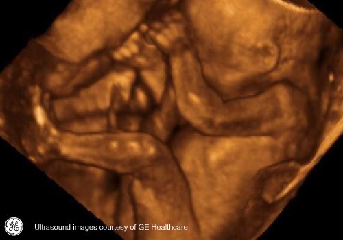 Week 21: Pregnancy Week By Week 3D Ultrasound Images