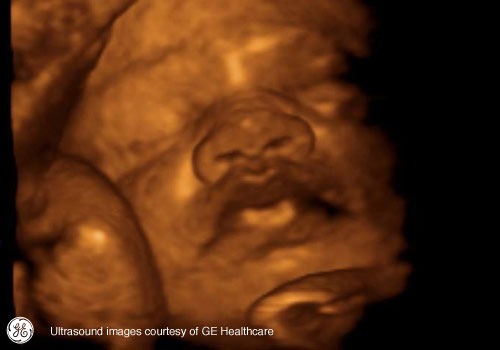 Week 33: Pregnancy Week By Week 3D Ultrasound Images