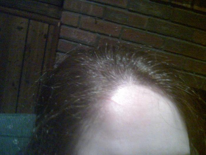 Newest head injury...  Using a cell phone camera...