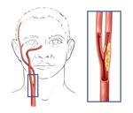 carotid artery pain 