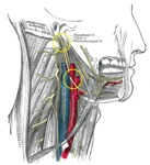 Hypoglossal nerve irritation