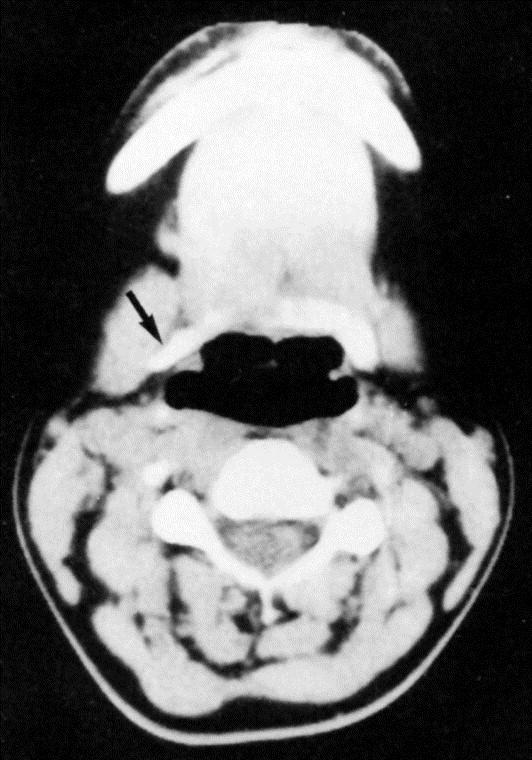 Ct of woman with abnormal lateral curvature of hyoid