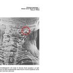 Hyoid Bone Left Greater Cornu Abnormality