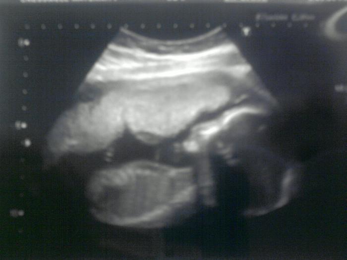 20 week scan - clear view of spine and also she was resting her hand on her belly :)
