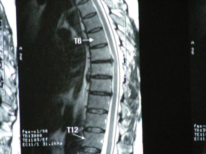 My Back MRI 2