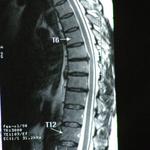 My Back MRI 2