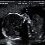 19 week ultrasound (ITS A GIRL)