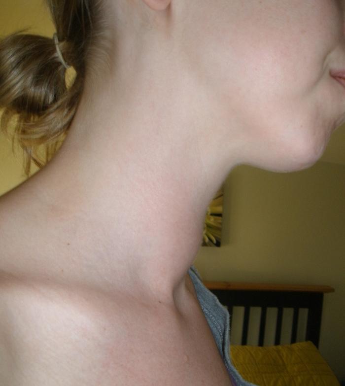 swollen neck after RAI