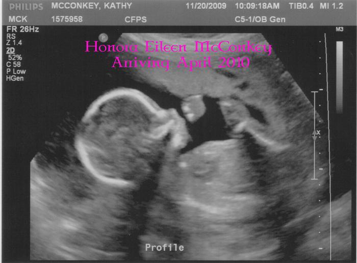 20 week Ultrasound picture