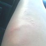 my leg after it got cold from laying it on a cold 2 liter.....hives started
