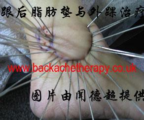 Silver acupuncture in China