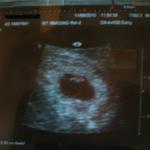 6 weeks ...fetal pole, heartbeat, yolk sac