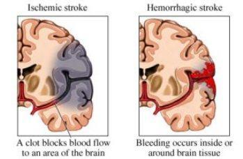 Two Types of Stroke Distinguished