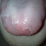 This is my geographic tongue. I am HIV, HSV-2, Syphilis, Chlamydia, and Gonorrhea negative.