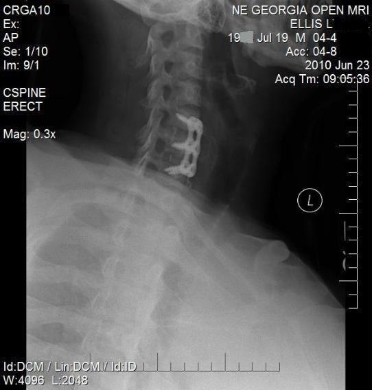 another view cervical fusion 