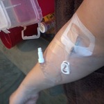 my inhome IV for the steroid treatment