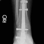 Ankle X-Ray 2011