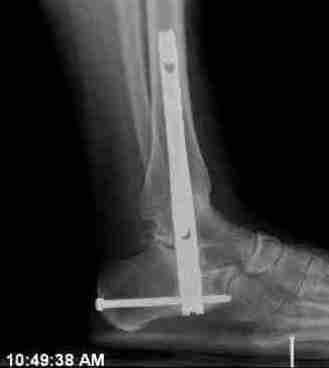 Ankle X-Ray 2011