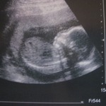 20w5d 3rd March 2011