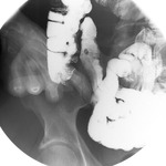 appendix X-ray 01