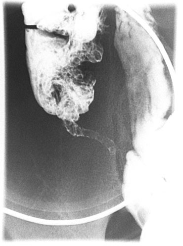 appendix X-ray 02