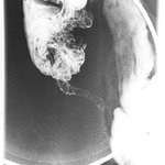 appendix X-ray 02