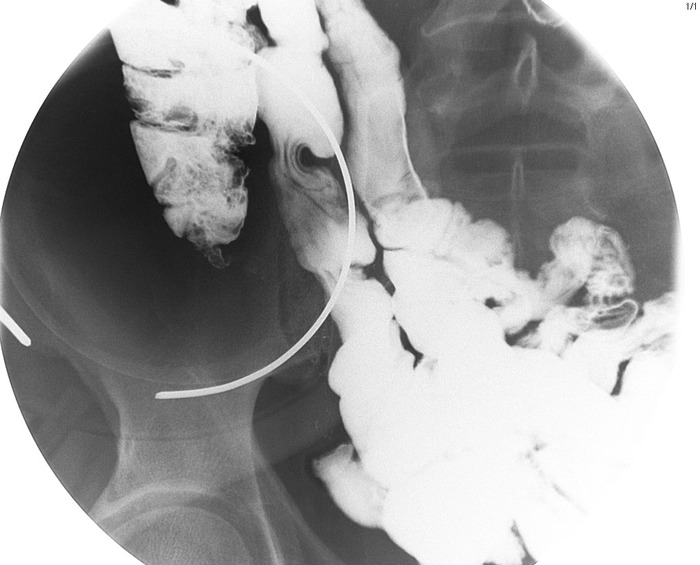 appendix X-ray 04