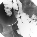 appendix X-ray 04