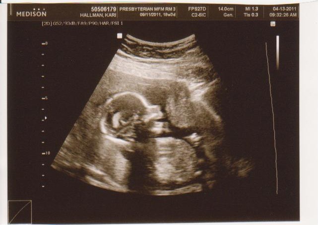 looks like baby girl is smiling :-) (18 week scan)