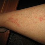 This type of rash happened just once.  Was mortified!