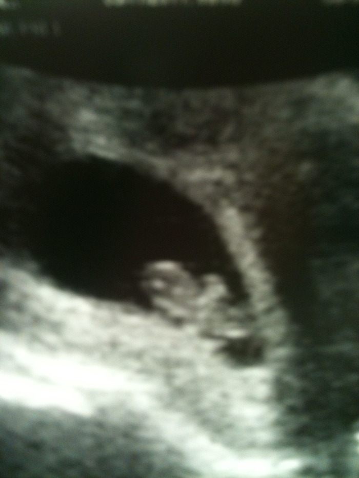 My first ultrasound at 9 weeks!