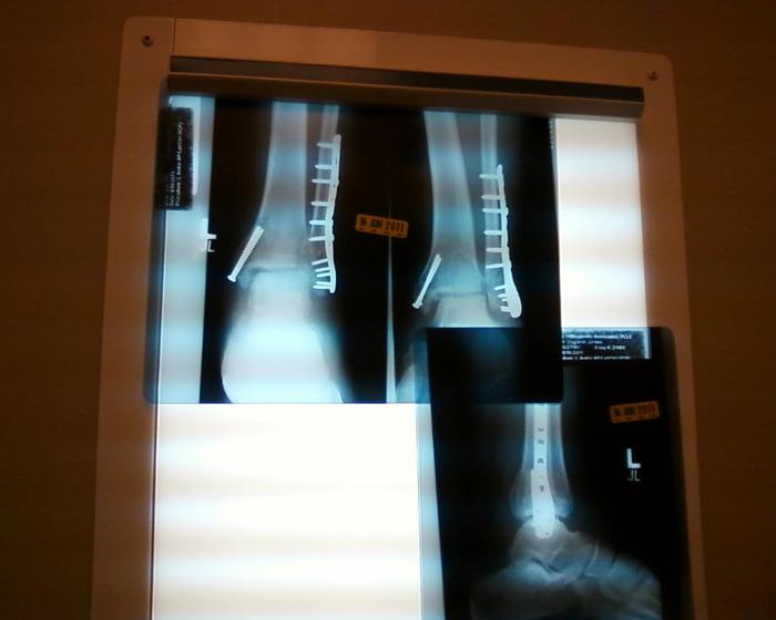 After shattering ankle & breaking leg in 4 places, 13 screws & a rod put me back together again.