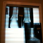 After shattering ankle & breaking leg in 4 places, 13 screws & a rod put me back together again.