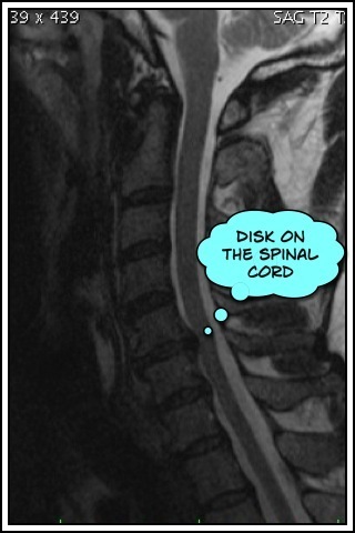 Disk pressing on the spinal cord
