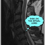 Disk pressing on the spinal cord