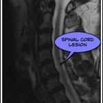 MS lesion on the spine cord just above the C5 disk