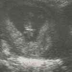 10 week scan - My little gummy bear