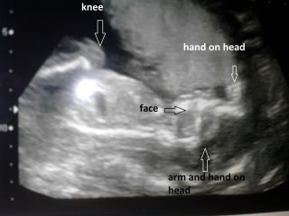 20 weeks scan my amazing little girl :) 