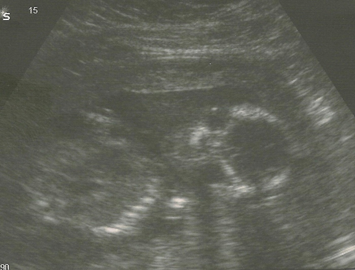 18 week scan - My little BABY GIRL!!! :D