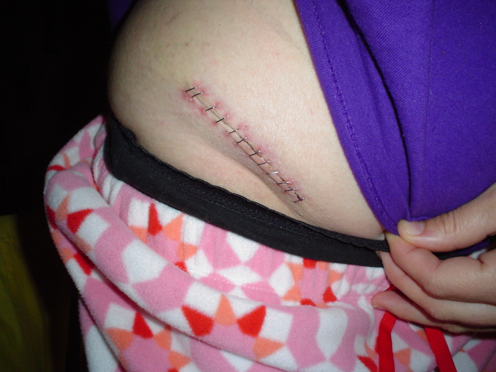 Hip incision with staples (swollen) - 4 days post op.