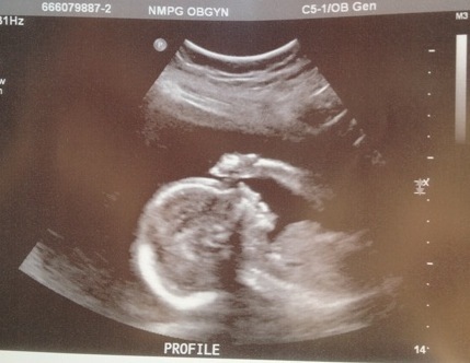 It's a Girl! at 20 weeks :)