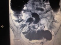compare with my small bowel enema , same bumpy appearance in ileum area , is this normal ??