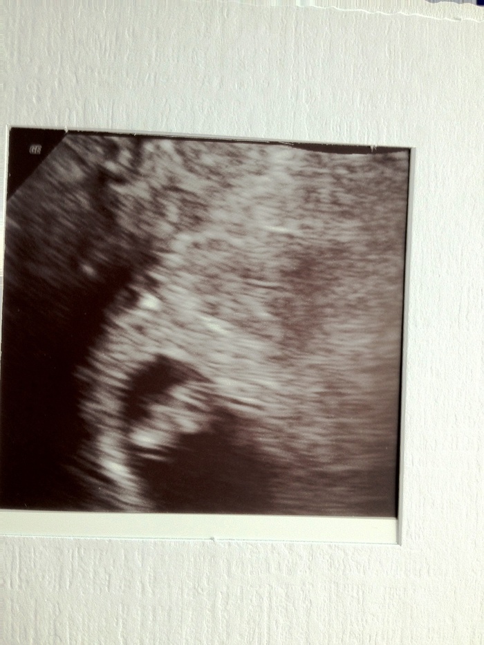 2nd Ultrasound at 7 weeks 6 days HB 148
